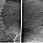 Dar Kanal (Lomber Spinal Stenoz): Belirtiler, Tedavi ve Cerrahi Seçenekler
