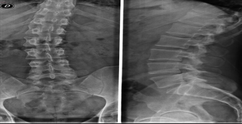 Dar Kanal (Lomber Spinal Stenoz): Belirtiler, Tedavi ve Cerrahi Seçenekler