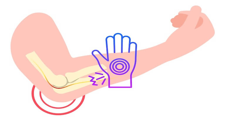 Bilgisayar Başında Çalışanlarda Kubital Tünel Sendromu Riski ve Korunma Yolları