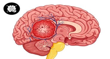 Baş Ağrısı ve Beyin Tümörü: Ne Zaman Ciddiye Alınmalı?
